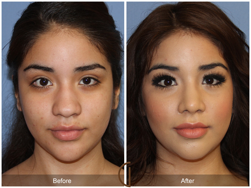 Ethnic Before & After Image
