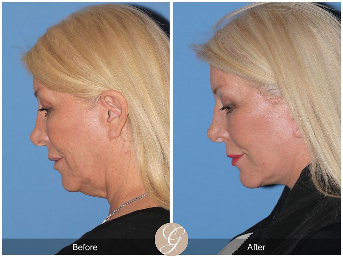 Face Galleries Before & After Image