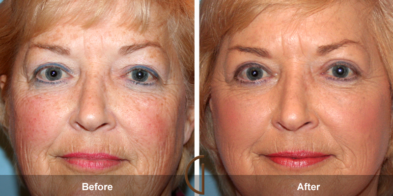 Eyelid Surgery Before & After Image