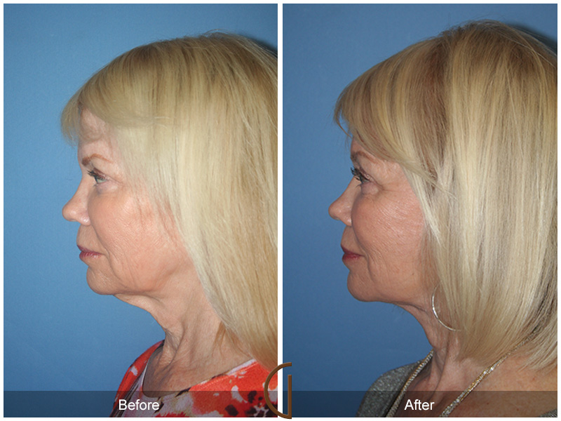 Female Facelift  Before & After Image