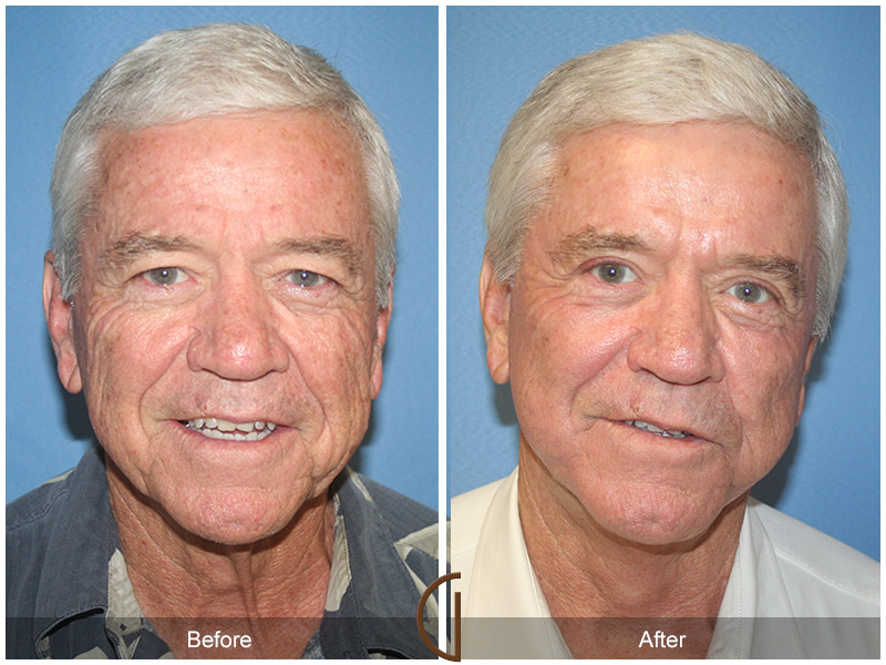 Before and after gallery for male facelift patient 03