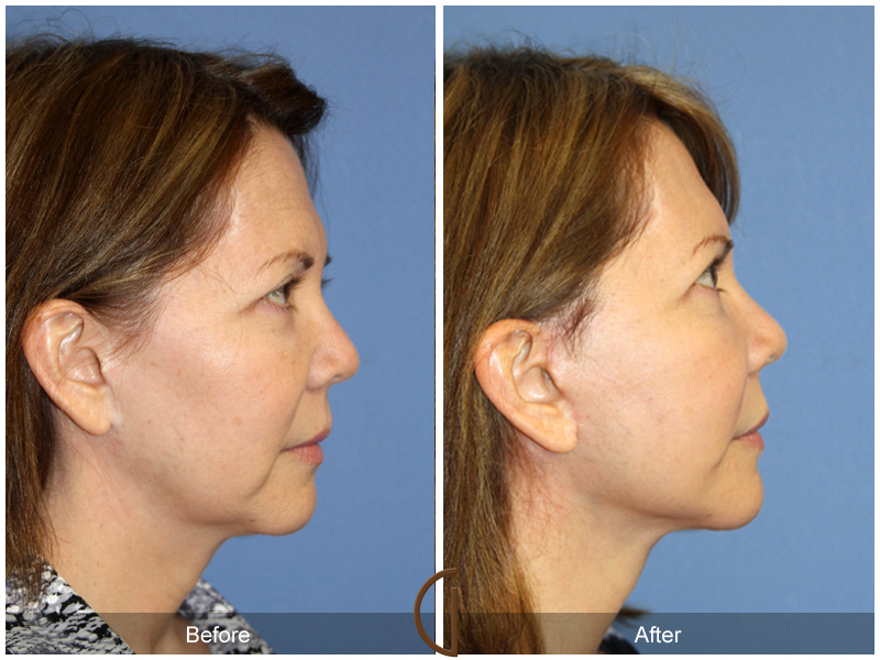 Revision Facelift Before & After Image