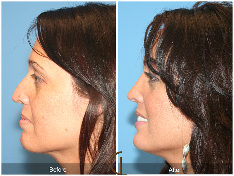 Before and after gallery for female rhinoplasty patient 50