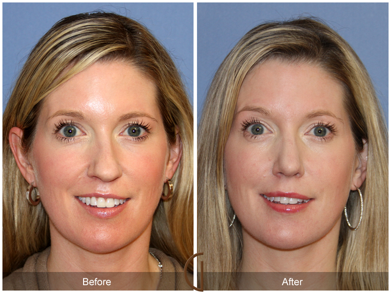 Female Rhinoplasty Before & After Image