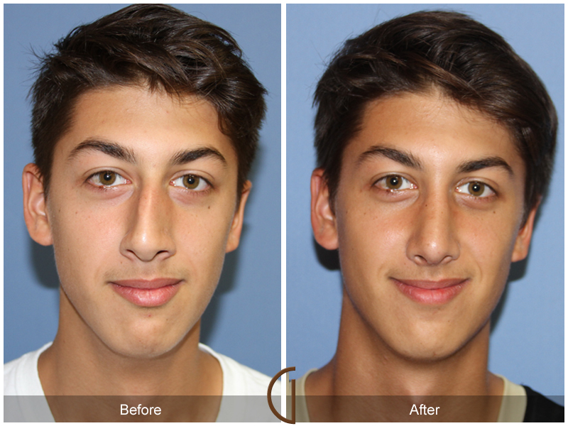 deviated septum surgery before and after