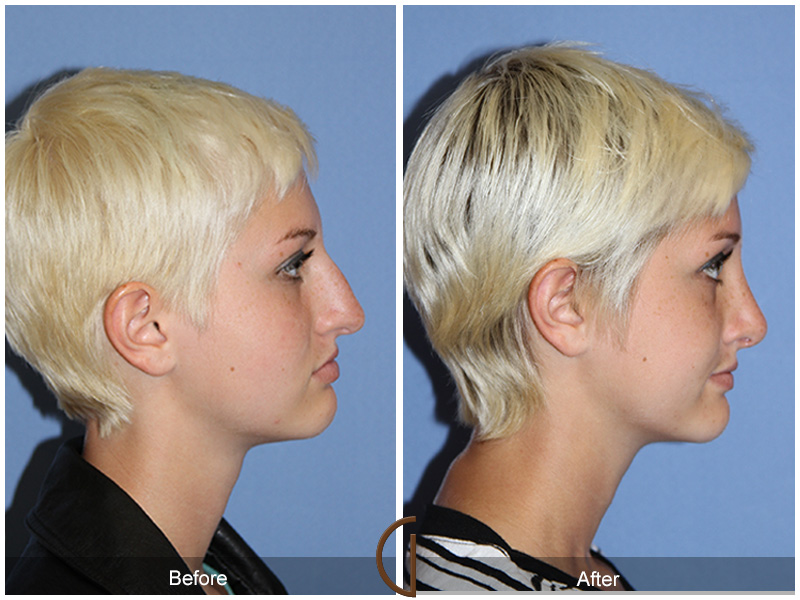 Before and after gallery for teen rhinoplasty patient 4